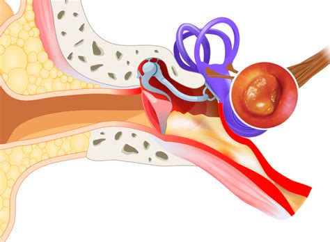 Otitis Media