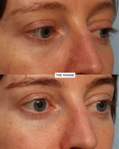 Tear Trough Filler Sydney See Our Doctors Who Are Dermal Filler Experts