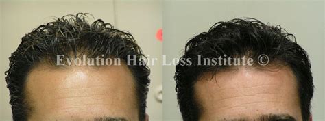 Before and After Hair Growth Treatment Photos