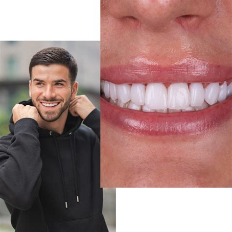 Carillas Dentales en Valencia Sofía Cortés Clínica Dental