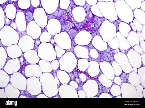 Fat necrosis, light micrograph Stock Photo - Alamy