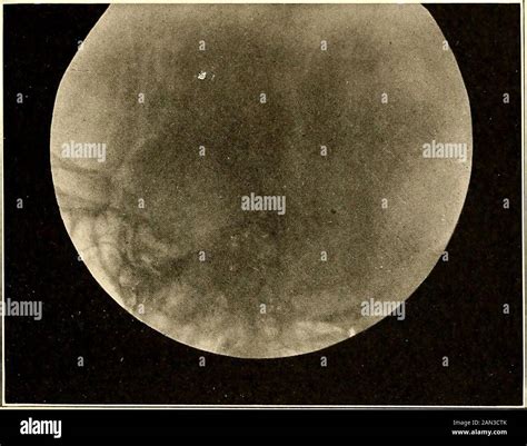 Roentgen Diagnosis Of Diseases Of The Head The Existenceof Widened