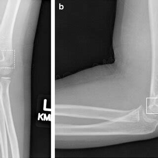 Anteroposterior A And Lateral B Radiographs Of The Left Elbow In A