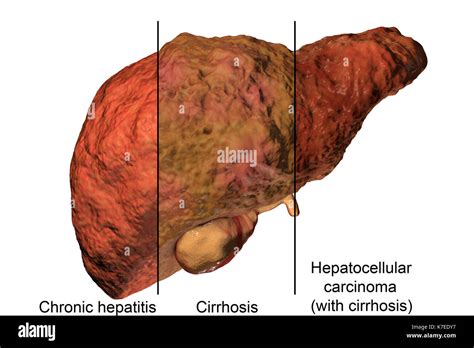 Il Fegato Umano Che Mostra Fasi Di Malattia Del Fegato E Un Virus Di