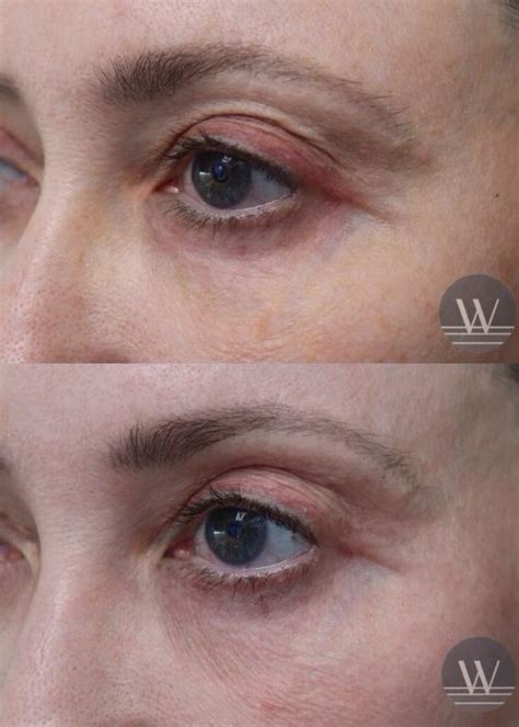 laser coring case  west institute chevy chase dermatology
