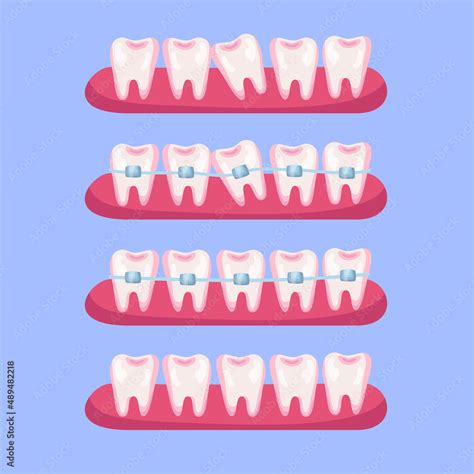 Teeth before and after braces cartoon illustration set. Stages of ...