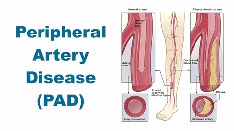 Understanding Peripheral Artery Disease A Disability Or Not