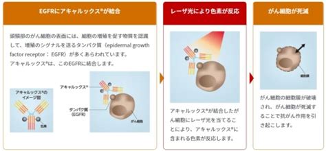 がん光免疫療法を開始します ｜ News ｜ 札幌医科大学 耳鼻咽喉科・頭頸部外科学講座