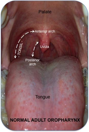 Tonsillitis —