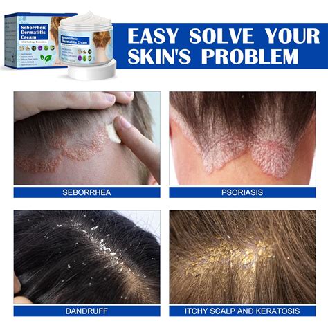 Buy Psoriasis Cream Seborrheic Dermatitis Cream Scalp Treatment For Psoriasis Folliculitis