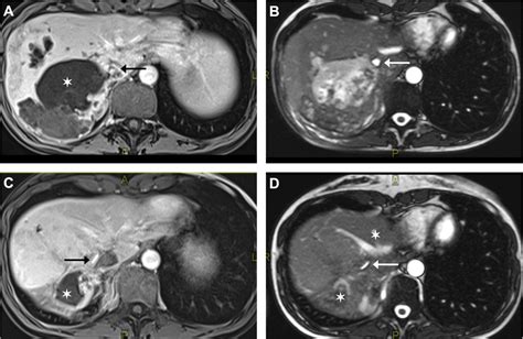 Vascular Pathology In Patients With Alveolar Echinococcosis Framework For Assessment And