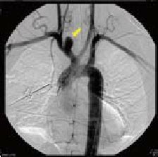 ( A ) “Normal aortic arch” anatomy, ( B ) “Bovine aortic arch,” ( C ...