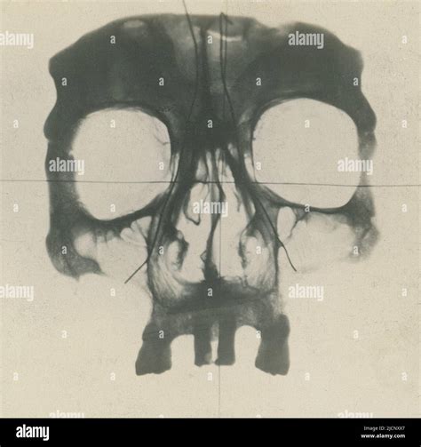 Human skull, X-ray Stock Photo - Alamy