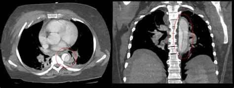 Aortic Dissection Classification Management TeachMeSurgery