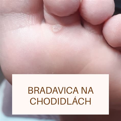 Bradavica Na Chodidl Ch Pedante