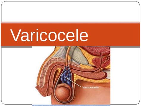 Blog de Urologia Cid Zauli A correção cirúrgica da varicocele no homem