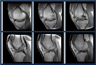 Resonancia Magn Tica De La Rodilla