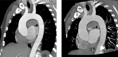 Best Ct Scan For Aortic Angiography Near Me Nanded City Pune