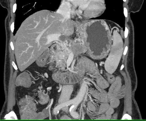 Pancreatic Cancer Invades The Portal Vein Splenic Vein And Superior