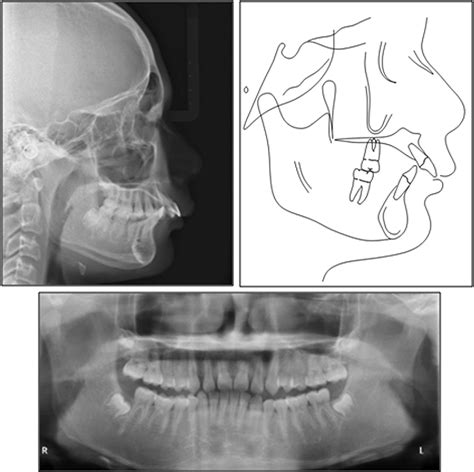 Figure From Severe Class Ii Division Malocclusion In An Adolescent