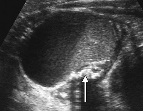 Dermoid Ovarian Cyst Ultrasound