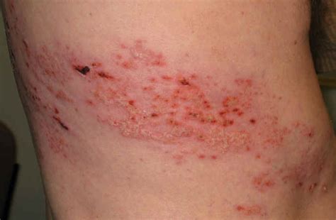 Here Are Some Home Remedies For Shingles | +ADw-/title+AD4-Hacked By TURKHACKTEAM.ORG Putin ...