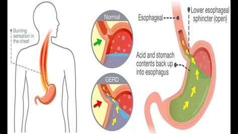 How To Get Rid Of Heartburn 6 Home Remedies For Instant Relief Youtube