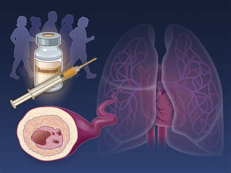 Sotatercept For Pulmonary Arterial Hypertension NEJM