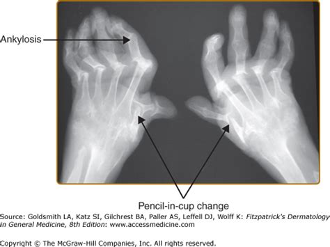 Psoriatic Arthritis | Plastic Surgery Key