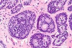 Cribriform pattern - Libre Pathology