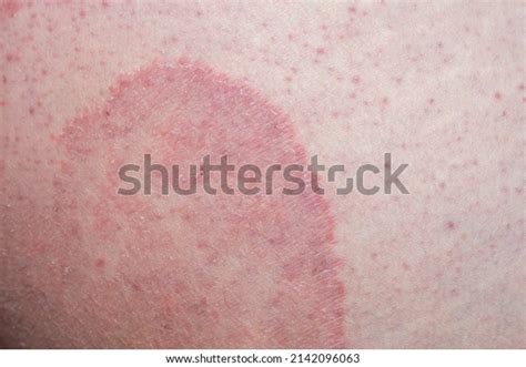 Tinea Cruris Known Jock Itch Common Stock Photo 2142096063 Shutterstock