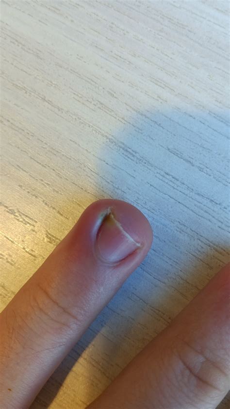 It looks like I have fingernail fungus. : r/firstaid