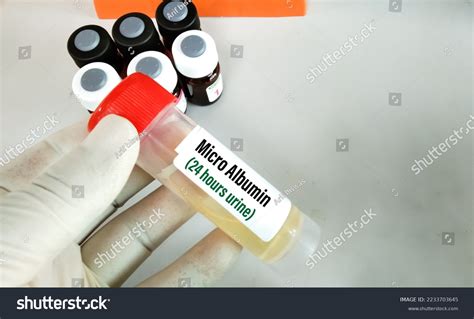 Urine Albumin Micro Albumin 24 Hours Stock Photo 2233703645 | Shutterstock