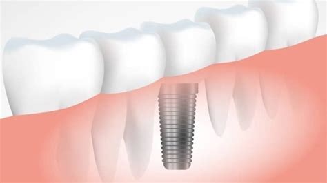 Implantes Dentales Todo Lo Que Debes Saber Dental Garrido