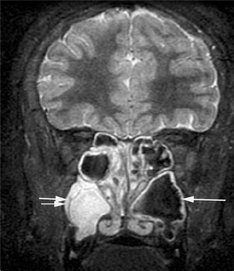 CT scan in coronal plane shows an ostiomeatal | Download Scientific Diagram