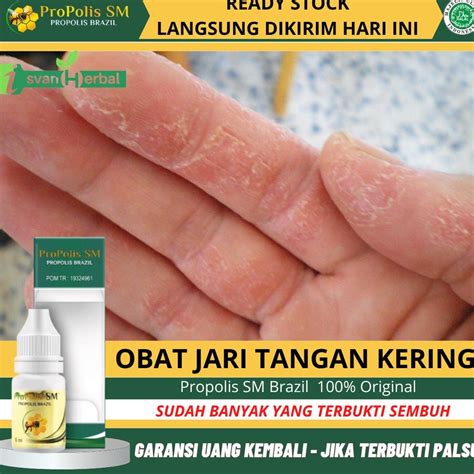 Jual Obat Jari Tangan Pecah Pecah Telapak Tangan Kasar Kuman Air