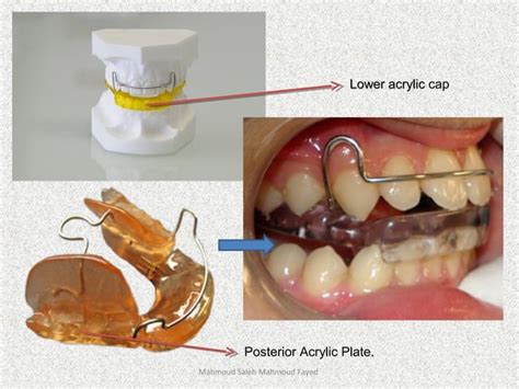 Orthodontic Appliances Ppt