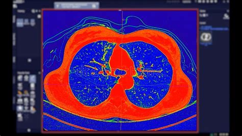 Ct Scan Of Chest Axial View In Color Mode For Diagnostic Pulmonary