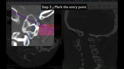 C2 Pedicle Screw Trajectory Planning Using Horos Youtube