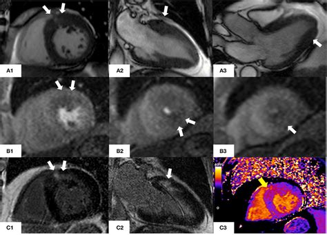 Cmr Findings In A Year Old Man With Asymmetric Hypertrophic