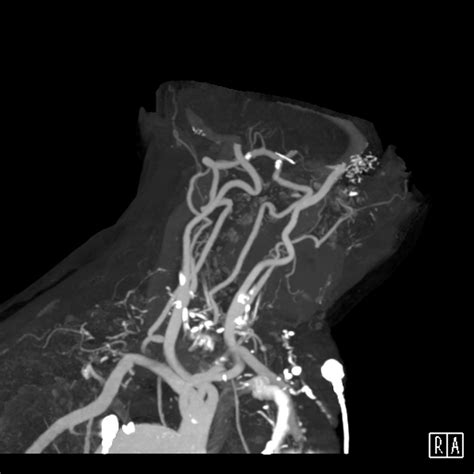 Fileacute Right Mca Infarct Meningioma And Retinal Detachment Ct