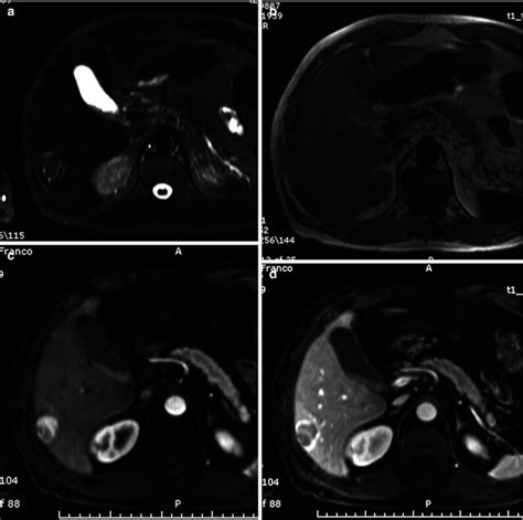 Other Malignant Lesions Of The Liver Radiology Key