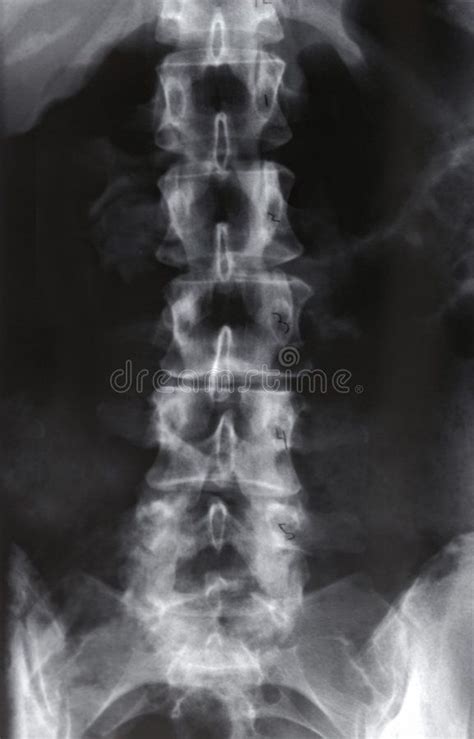 Xray Lumbar Spine Anteroposterior Xray Of The Lumbar Spine Shows