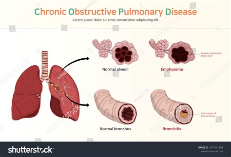 Copd Chronic Obstructive Pulmonary Disease Royalty Free Stock Vector 1471541663