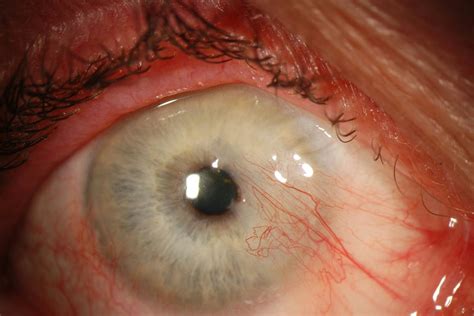 Pterygium Surgery Aksha Eye Hospital Rajkot