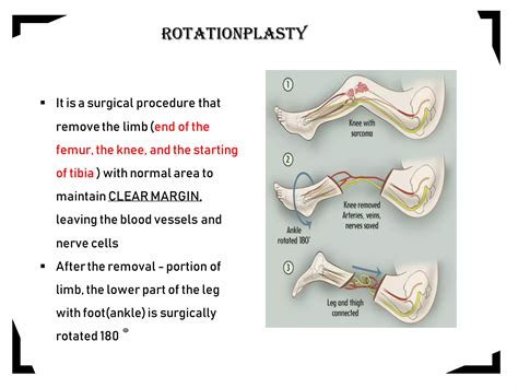 Rotationplasty Pdf