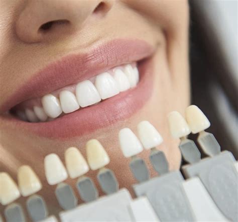 Qué son las Carillas Dentales y para qué se Utilizan Clinica Dental