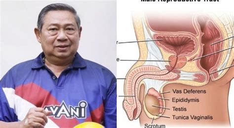 Sby Didiagnosa Mengalami Kanker Prostat Apa Saja Gejala Dan Bagaimana