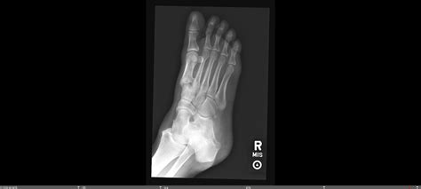 1st Metatarsal Base Fracture — Chicago Foot & Ankle Orthopaedic Surgeons