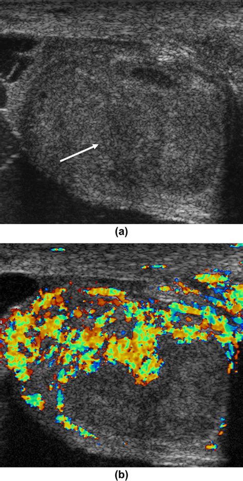 Segmental Testicular Infarction A Focal Mixed Reflective Area